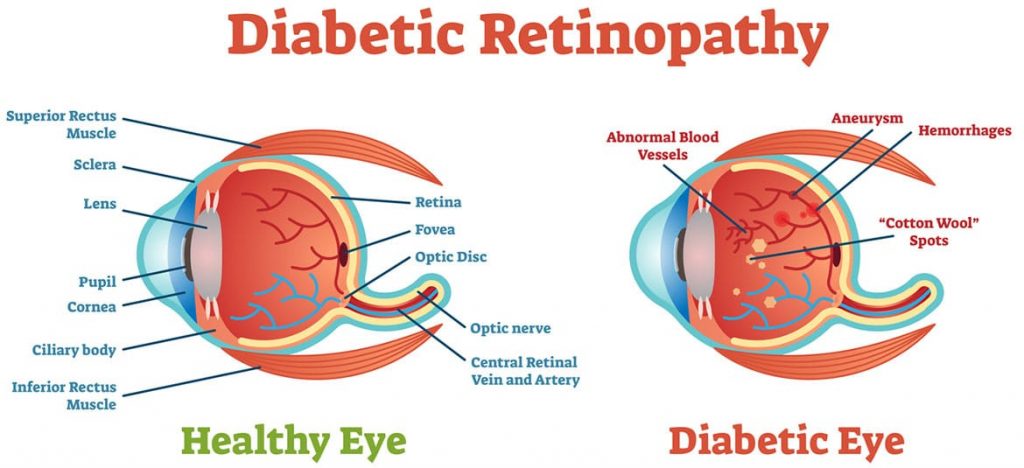 Diabetic Retinopathy causes