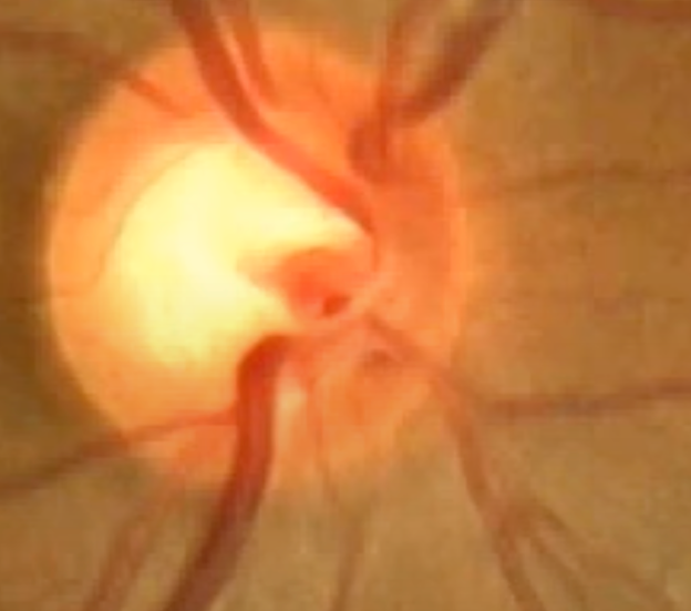 how to test for glaucoma