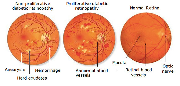 types of Diabetic Retinopathy
