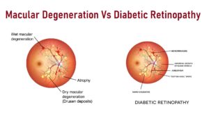 Macular Degeneration Vs Diabetic Retinopathy