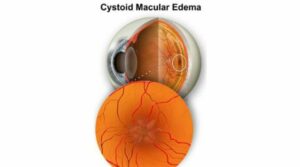 Cystoid Macular Degeneration