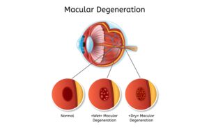 stages of macular degeneration