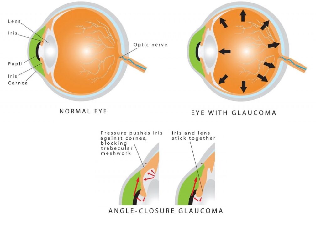 acute angle closure glaucoma