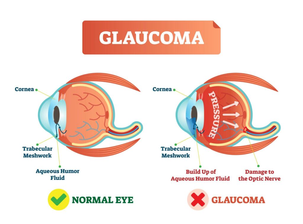 What does glaucoma vision look like