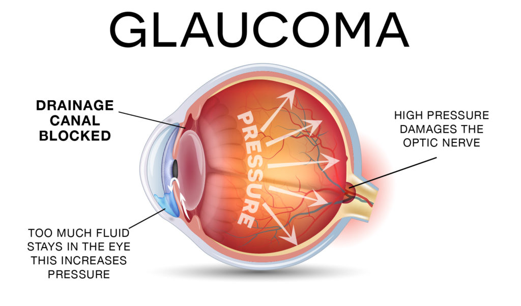 Stages of Glaucoma