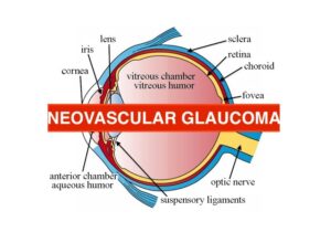 neovascular glaucoma