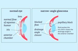 narrow angle glaucoma