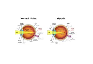 Degenerative Myopia