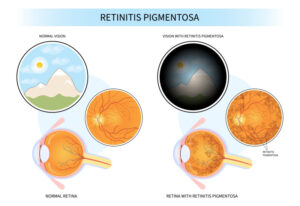 Retinitis Pigmentosa Inheritance