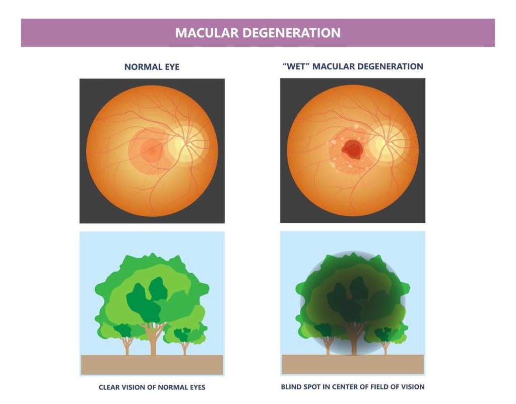 What Causes Wet Macular Degeneration