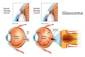 secondary glaucoma