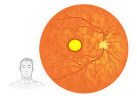 What is Vitelliform Macular Dystrophy