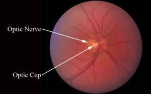 optic nerve cupping