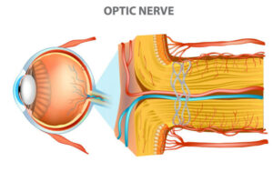 how does glaucoma affect the optic nerve