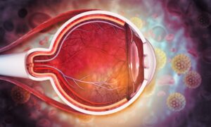 large optic nerve without glaucoma