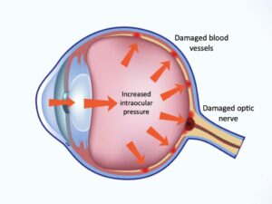 Primary Congenital Glaucoma