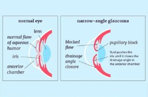 Narrow Angle Eye