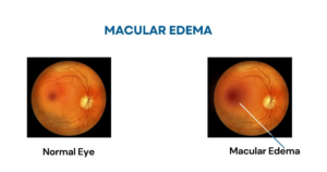Treatment For Macular Edema