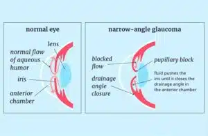 Anatomical narrow angle glaucoma